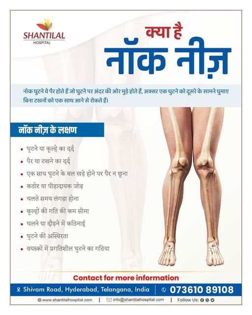 Knock Knee (Knock Niza) | Shantilal Hospital